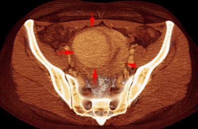 Mioma uterino