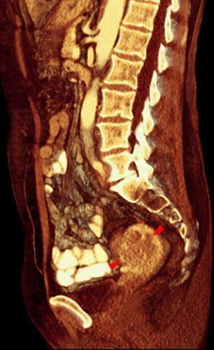 Tumor de endometrio 2