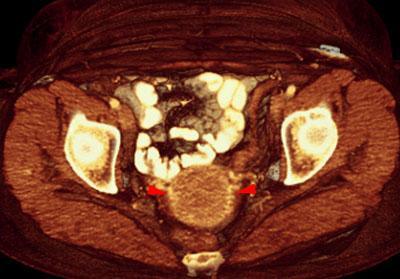 Tumor de endometrio 2