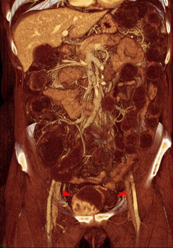 Sarcoma uterino