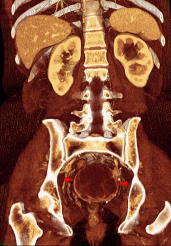 Sarcoma uterino