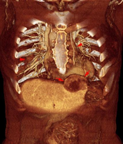 Recidiva y metástasis de neo de endometrio