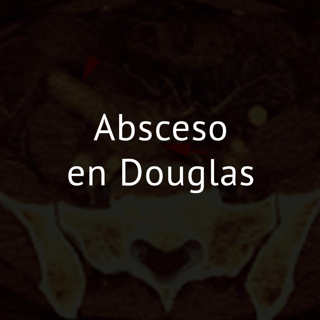 Absceso en Douglas