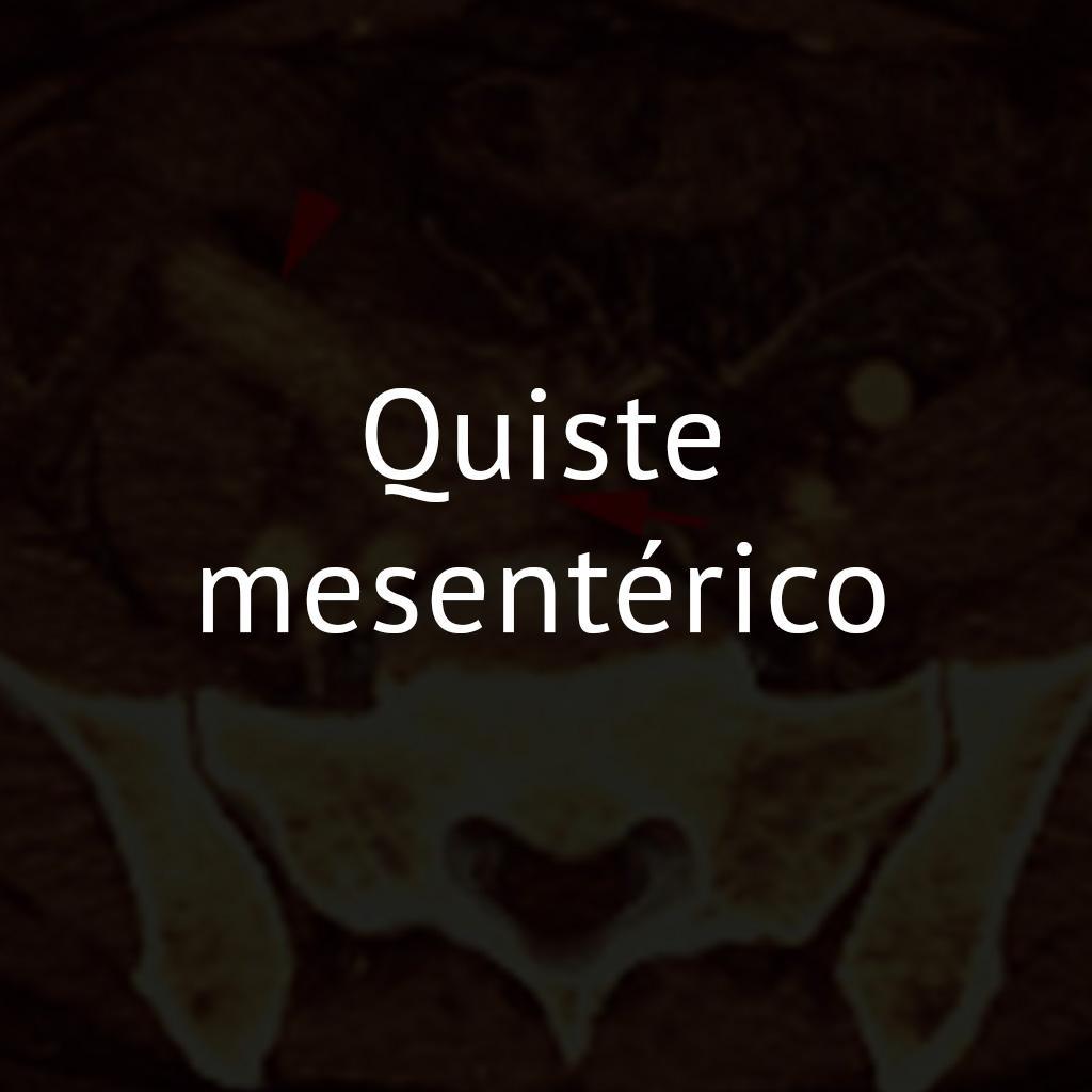 Quiste mesentérico