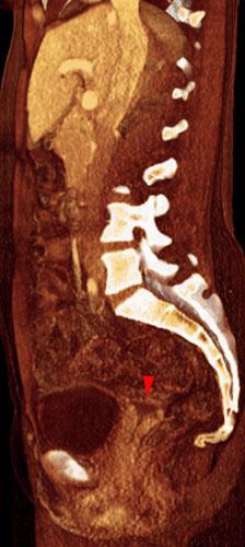 Absceso en cúpula vaginal post histerectomía