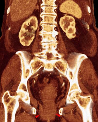 Prolapso rectovaginal 1