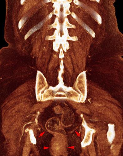 Prolapso rectovaginal 1