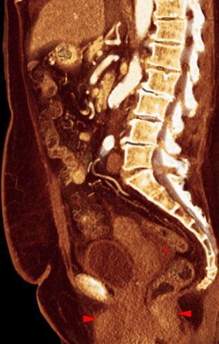 Prolapso rectovaginal 1