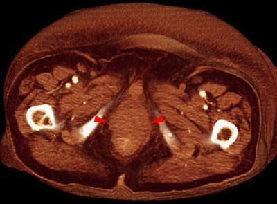 Prolapso rectovaginal 1