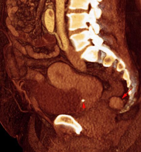 Fibroma perineal