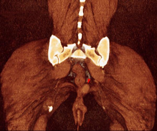 Fibroma perineal