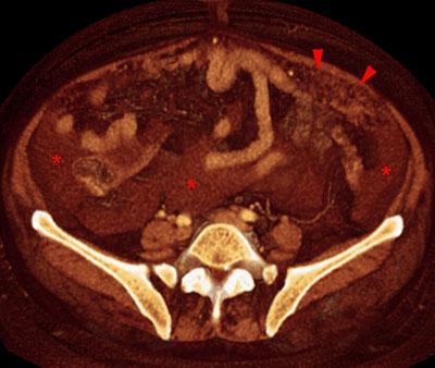 Carcinoma de ovario. Omental cake