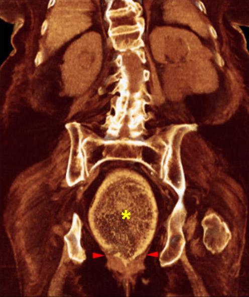 Prolapso rectovaginal 2