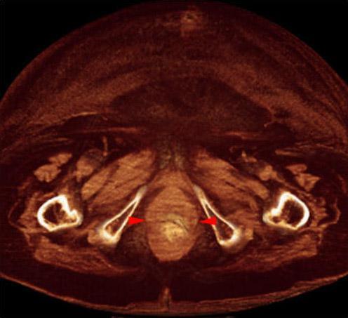 Prolapso rectovaginal 2