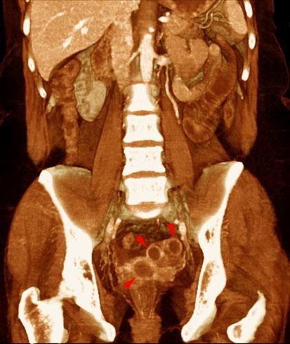 Piosalping