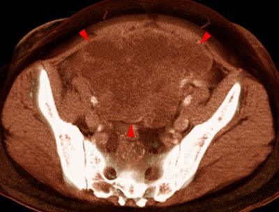 Carcinoma de ovario