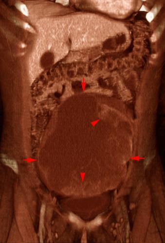 Carcinoma de ovario