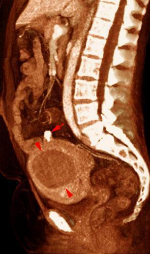Miomatosis uterina