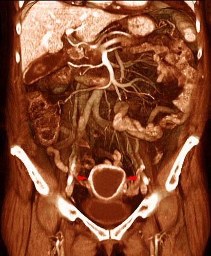 Sarcoma de bajo grado uterino
