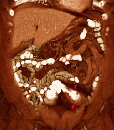 Absceso pélvico en diverticulitis aguda