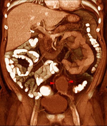 Absceso pélvico en diverticulitis aguda