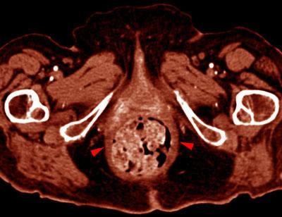 Prolapso rectal