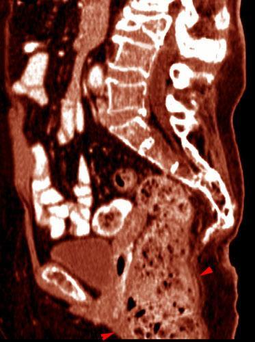Prolapso rectal