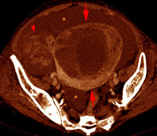 Carcinoma de ovario. Ascitis