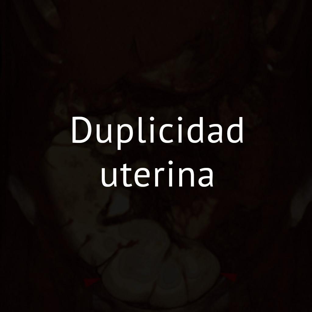 Duplicidad uterina