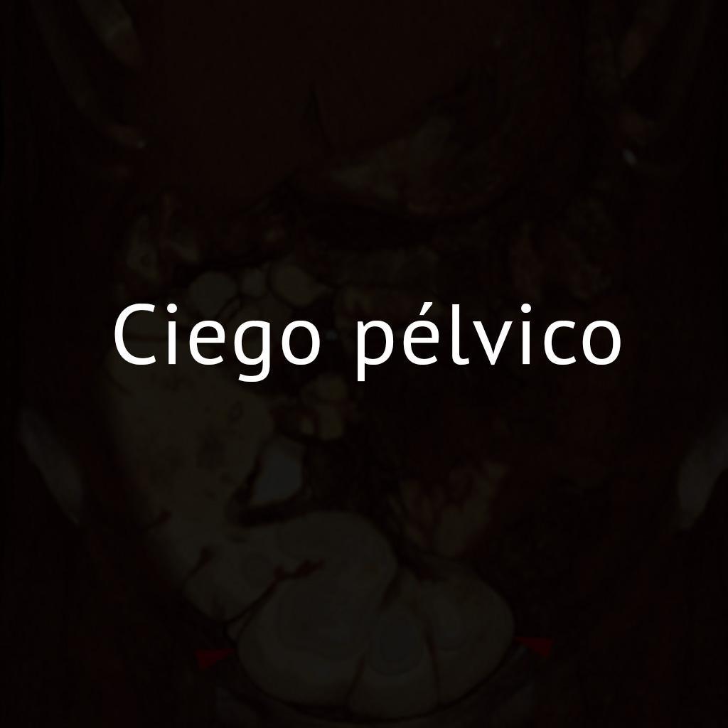 Ciego pélvico