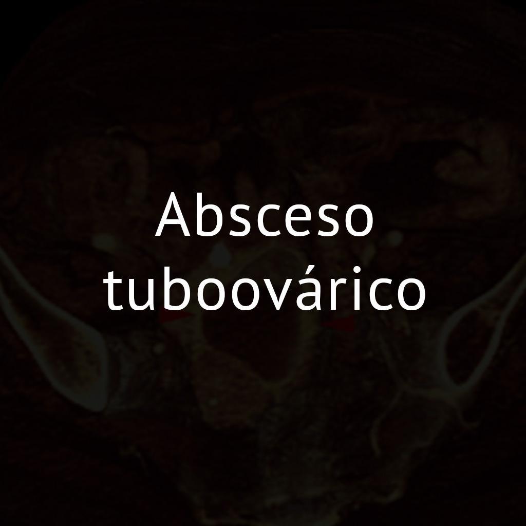 Absceso tuboovárico