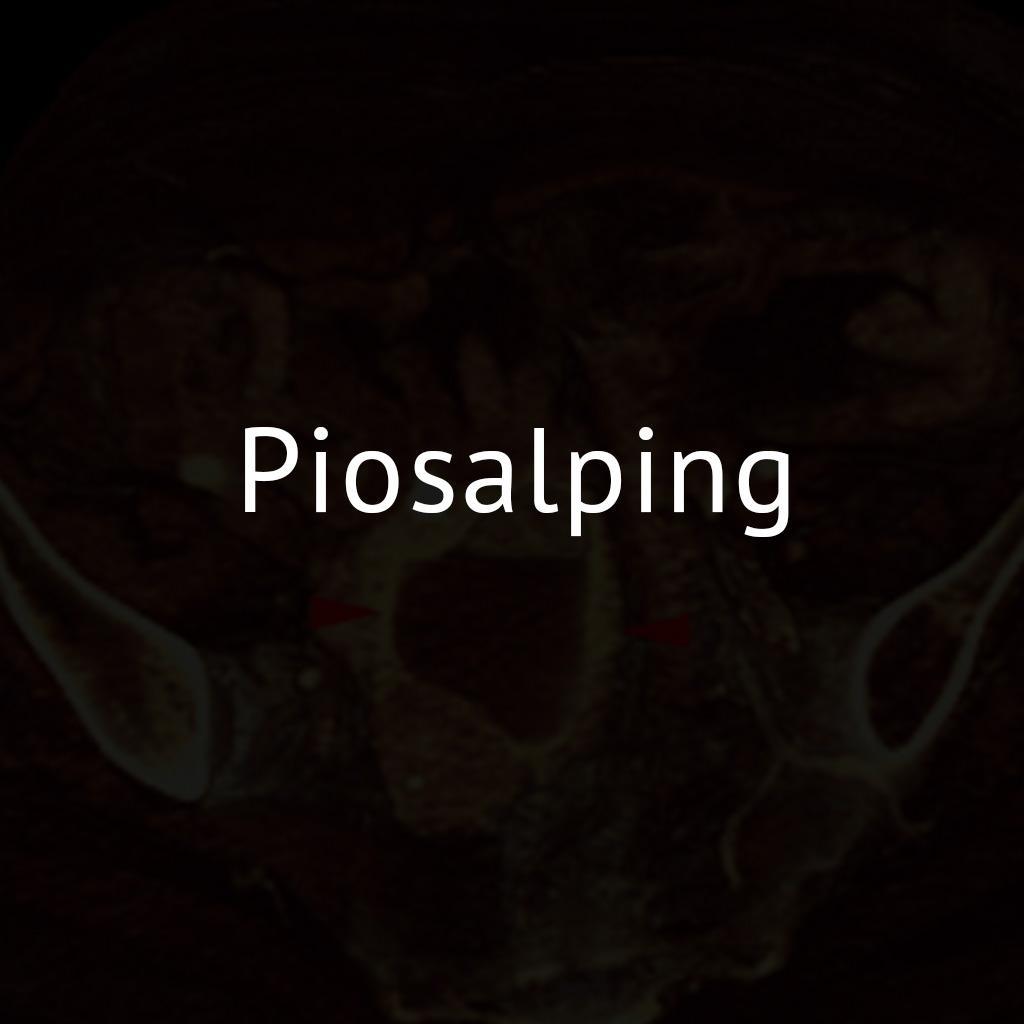 Piosalping