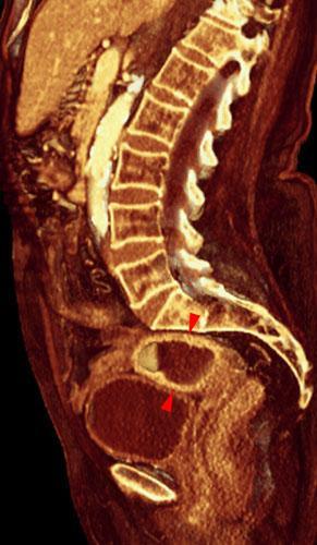Piometra
