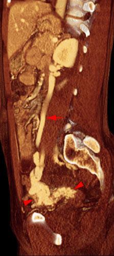 Varices uteroováricas
