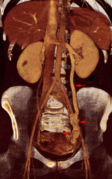 Varices uteroováricas