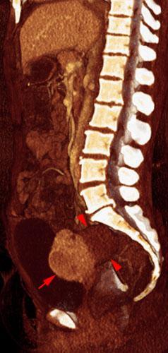 Quiste endometrial
