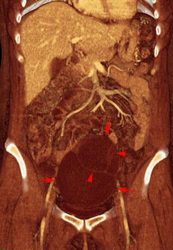 Cistoadenoma mucinoso