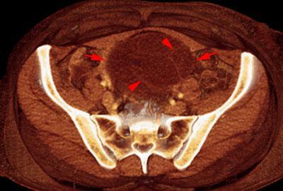 Cistoadenoma mucinoso
