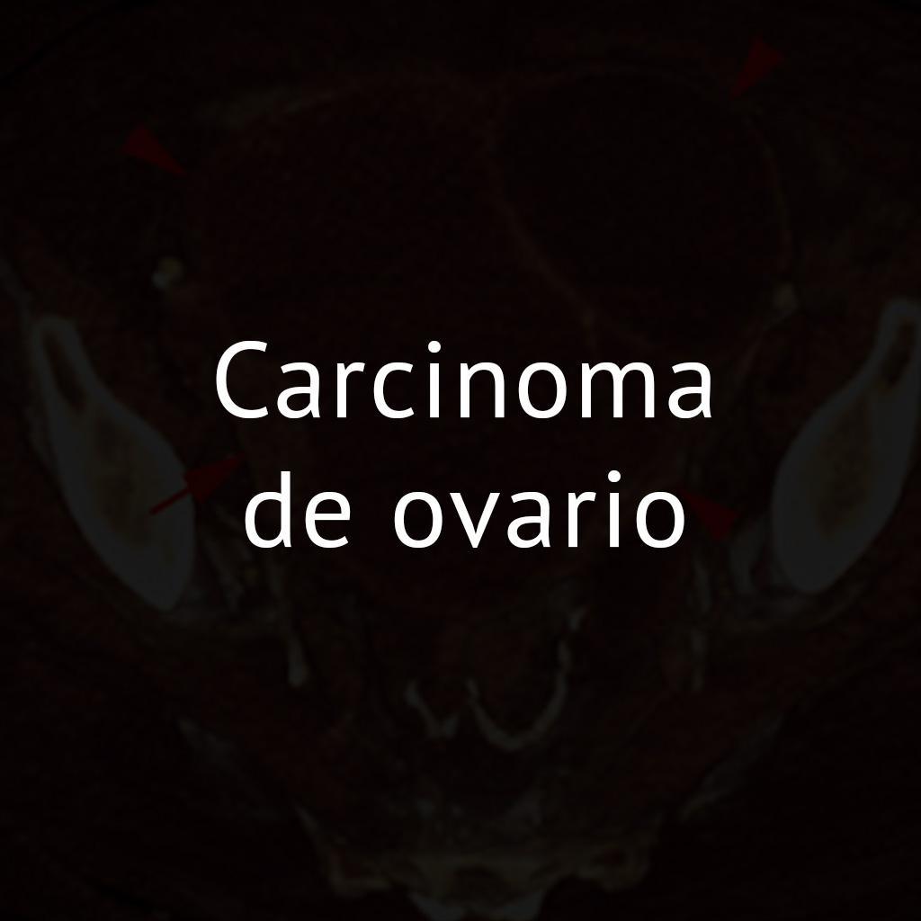 Carcinoma de ovario