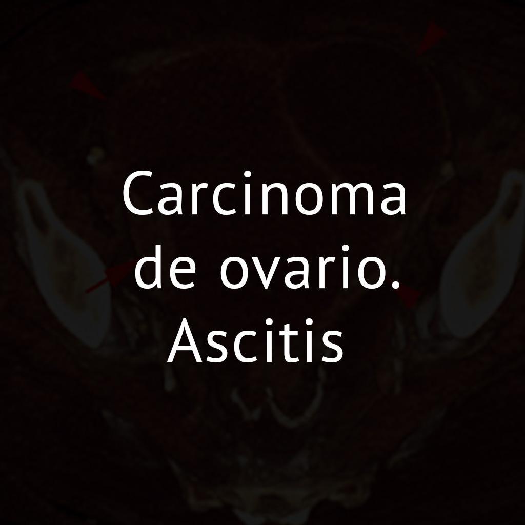 Carcinoma de ovario. Ascitis 