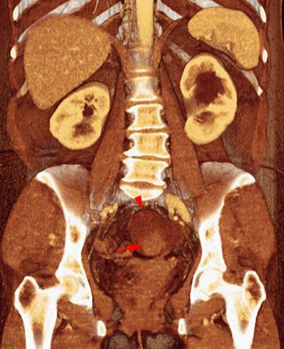 Quiste habitado Carcinoma ovárico