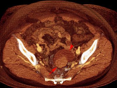 Quiste habitado Carcinoma ovárico