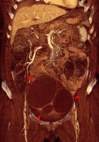 Cistoadenocarcinoma de ovario