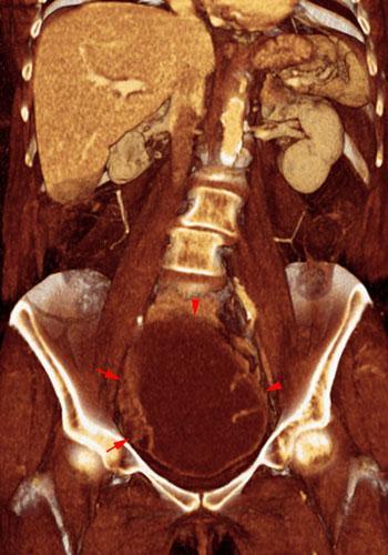 Cistoadenocarcinoma de ovario