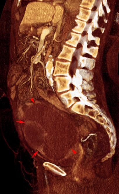 Cistoadenocarcinoma de ovario
