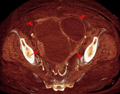 Cistoadenocarcinoma de ovario