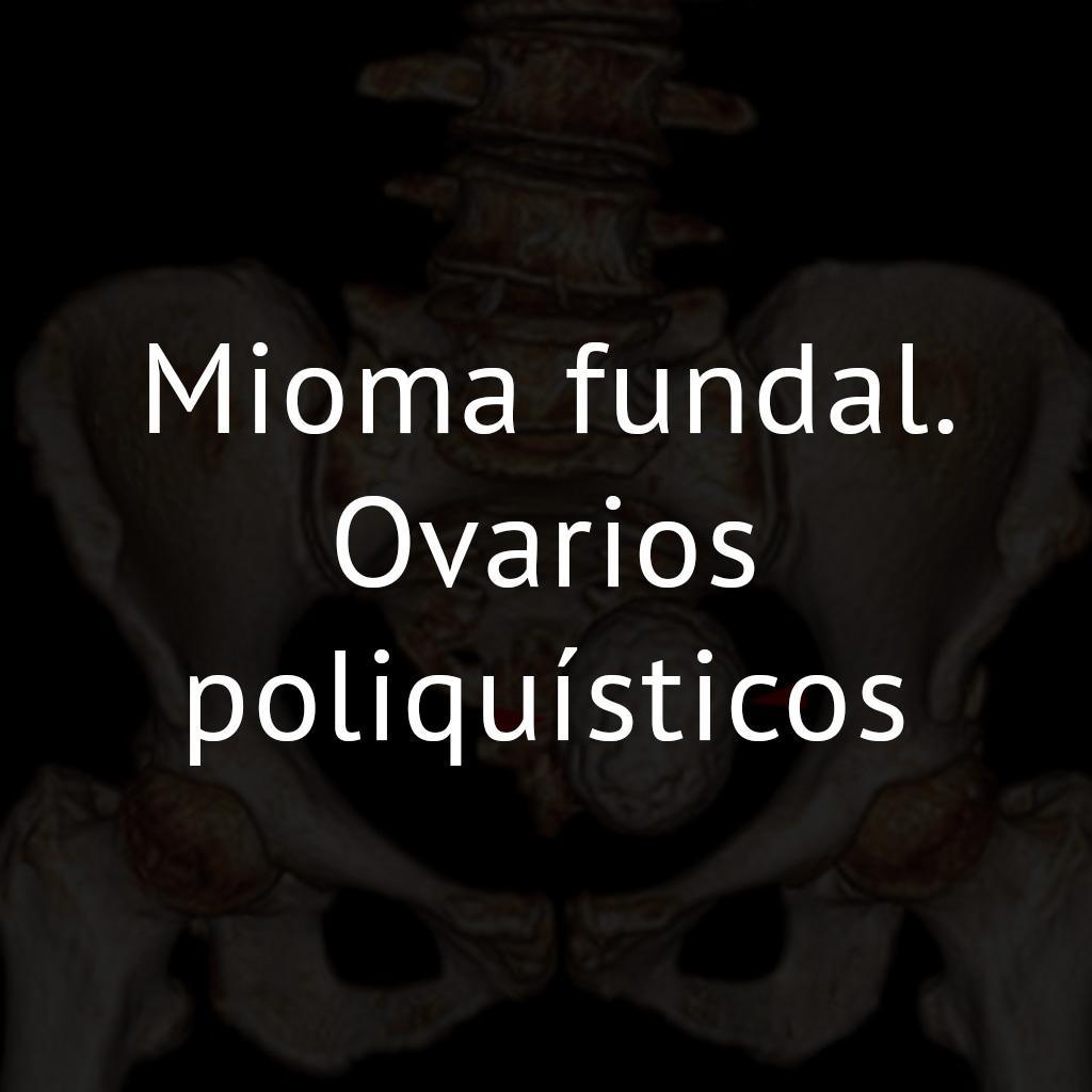 Mioma fundal. Ovarios poliquísticos