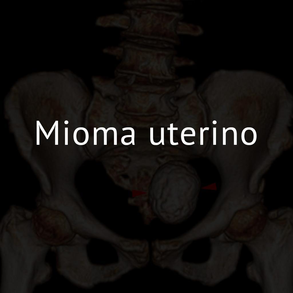 Mioma uterino 