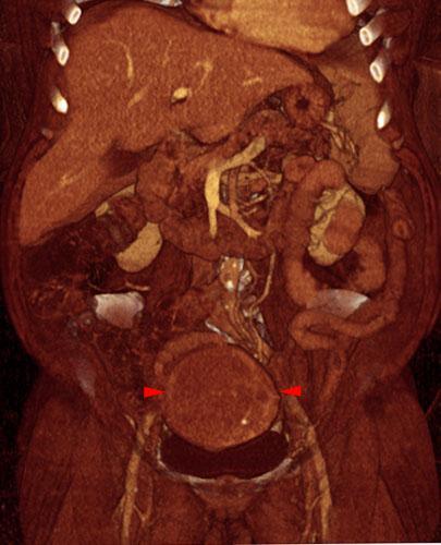 Mioma uterino calcificado