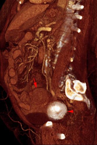 Mioma uterino calcificado